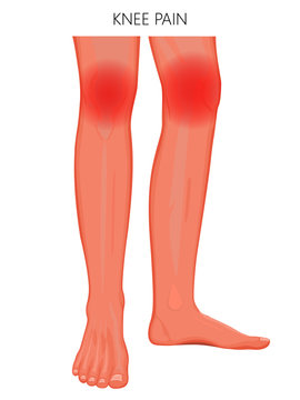 Vector illustration of a human legs (anterior and medial view) with knee joint pain or injury. For advertising, medical (health care) publications