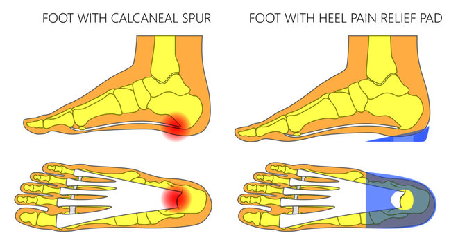 Vector Illustration. Human Foot With Calcaneal Spur, Plantar Fasciitis Problem Before, After Heel Pain Relief Pad. Medial, Side And Plantar View Of A Foot. For Medical Publications