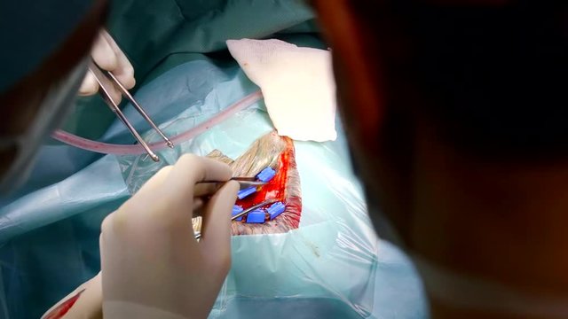close-up operation craniotomy to remove the tumor in the temporal lobe surgeon gently removes the skin from the hair opens access to the skull bone