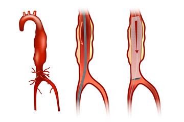 Endovascular aneurysm repair (or endovascular aortic repair) (EVAR)