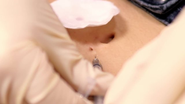 slow motion closeup piercing master does painkiller navel injection to client before procedure beginning