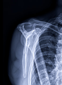 Radiographic image or x-ray image of Shoulder joint. additional view name is supraspinatus outlet