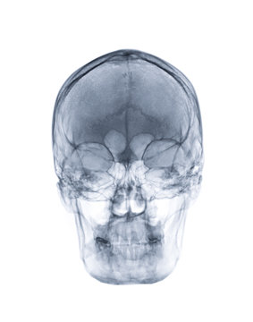  x-ray image of Human skull  AP view or front view invert filter technique isolated on white Background. Clipping path