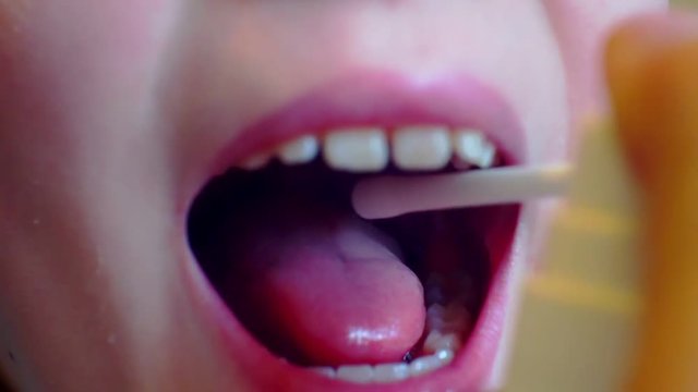 sore mouth and throat are treated with medication as a spray.close-up