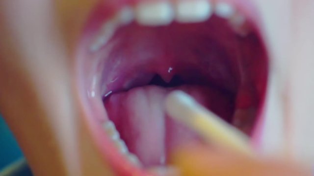 sore mouth and throat are treated with medication as a spray.close-up