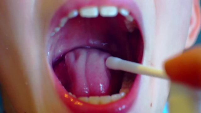 sore mouth and throat are treated with medication as a spray.close-up