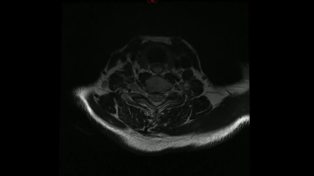 TAC tomografia assiale computerizzata cervicale