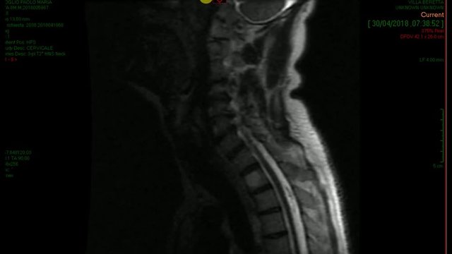 Tomografia colonna vertebrale
