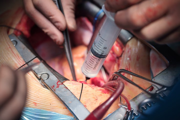 Stage of open heart surgery