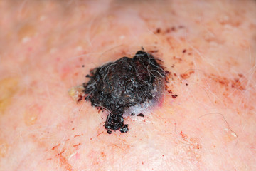 Malignant melanoma on the head of an old caucasian man - 241043997
