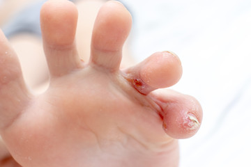 Fototapeta premium Dyshydrotic eczema, atopic dermatitis injury, damage on foot and toes of a child. Dermatology and pediatrics concept. Fungal infection treatment