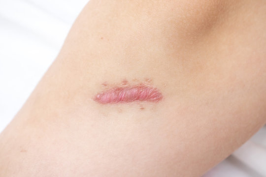 Close up of cyanotic keloid scar on leg caused by surgery and suturing, skin imperfections or defects. Hypertrophic Scar on skin, dermatology and cosmetology concept