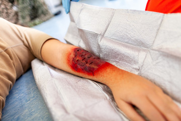 first aid bandage on burnt wound victim