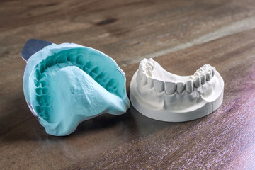 Set of upper and lower jaw dental molds