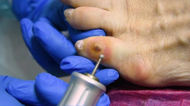 excision of calluses on the toe pedicure machine close-up