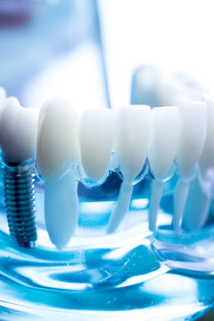Dentist dental teeth implant
