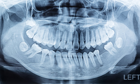 panoramic dental x-ray of a mouth lift and right side.