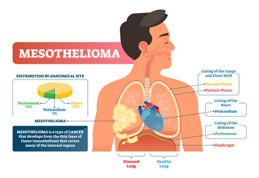 whats the best treatment for mesothelioma
