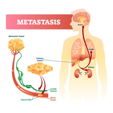 Metastasis vector illustration. Primary cancer and tumor labeled diagram.