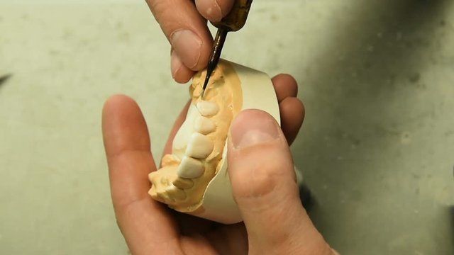 Dentist makes a dental implant prosthesis made of plaster cast. Orthopedic dentistry, prosthetics.