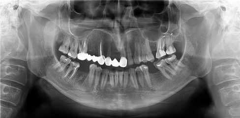 A panoramic radiograph is a panoramic scanning dental X-ray of the upper and lower jaw. This is a focal plane tomography shows the maxilla and mandible of a forty year old man.