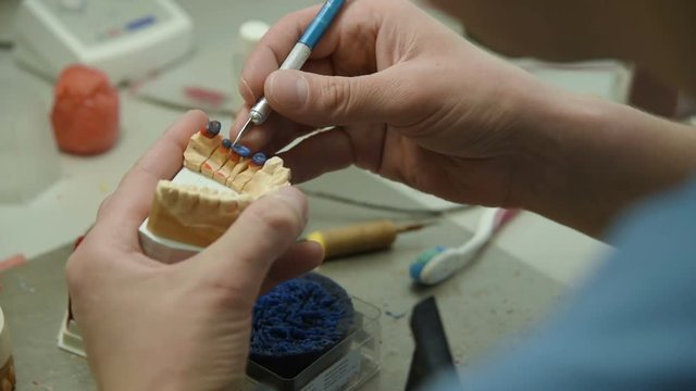The dentist makes a mold of the teeth. prosthetic dentistry, dental prosthetics
