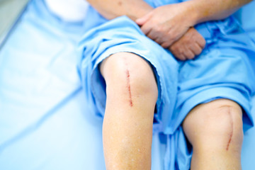 Asian senior or elderly old lady woman patient show her scars surgical total knee joint replacement Suture wound surgery arthroplasty on bed in nursing hospital ward : healthy strong medical concept.