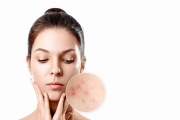 Young woman with acne skin in zoom circle. Skin care concept. Young girl, beauty portrait. Close-up.
