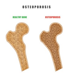 Color drawing of human thigh bone with osteoporosis problem on white background. Two bones are normal and sore. Vector illustration of the medical problem of osteoporosis disease
