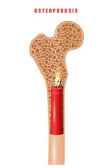 Color image of human thigh bone in cut with medicine problem osteoporosis on white background. Vector  item concept of a hidden disease osteoporosis in the form of dynamite sticks with a lit wick