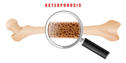 Color drawing of human thigh bone with osteoporosis problem on white background. Two bones are normal and sore. Vector illustration of the medical problem of osteoporosis disease