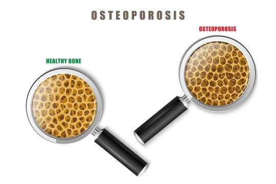 Color image of a human bone in cut with medicine problem of osteoporosis on a white background with magnifying glasses Vector item Osteoporosis under a microscope research invention treatment.