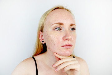 Oily and problem skin. Portrait of a blonde girl with acne, oily skin and pigmentation