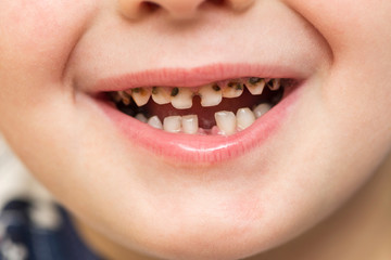 Kid patient open mouth showing cavities teeth decay. Close up of unhealthy baby teeth. Dental...