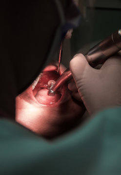 treatment of tooth caries, dental  close-up.