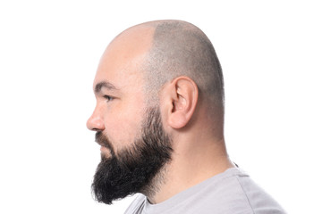 Man with hair loss problem on white background