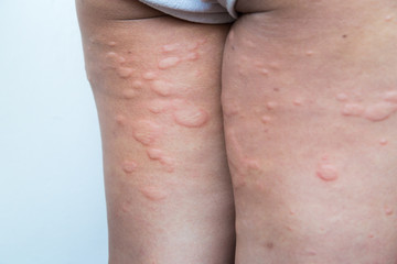 Skin rash in the legs