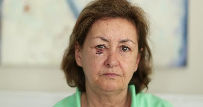 Older woman with bruised face looking to camera. Elder woman with post-surgery cancer scar