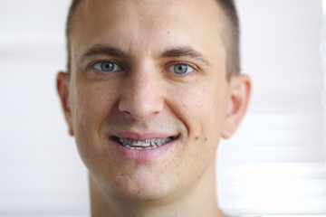 Portrait of man with crooked white ugly teeth close-up. Dental braces on the teeth in dentistry. Orthodontics and bite correction. Terrible smile. Problem, care and toothache