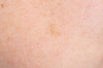 Closeup shot of skin blemishes