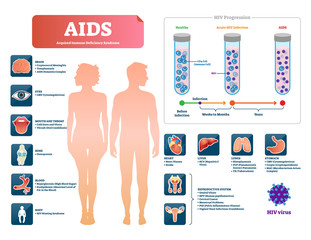 AIDS or HIV vector illustration. Labeled medical diagram with virus symptom - obrazy, fototapety, plakaty