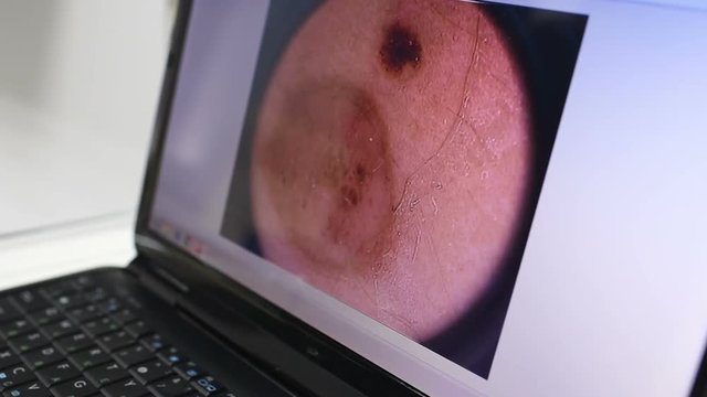 Image of a birthmark or warts close-up on a laptop monitor. Dermatology, dermatoscopy, prevention of melanoma, skin cancer.
