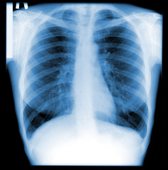 Vertical chest X-ray: manifestation of human bronchitis.