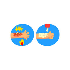 Thermal skin burn of hand, first aid and treatment vector Illustration on a white background
