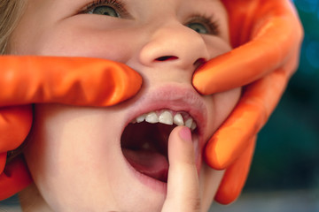 The doctor is trying to see the mouth of a little girl with an orthodontic appliance and crooked teeth.
