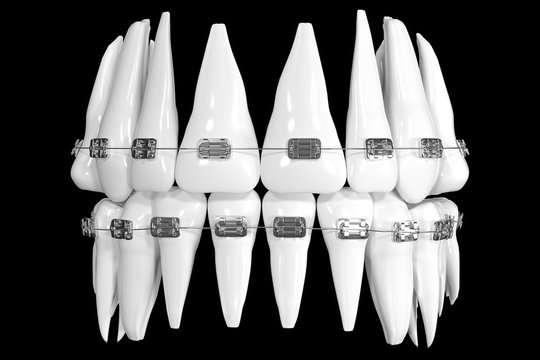 Quality dental model with braces, on black background. Photo-realistic illustration of a white teeth braces. Teeth icon isolated on black background. 3D render. Dental, medicine, health concept.