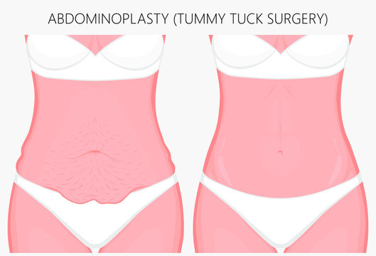 Realistic Vector illustration. Abdominoplasty, tummy tuck plastic surgery in woman. Front view. For advertising of cosmetic plastic procedures, stomach shunting, diet; for medical publications