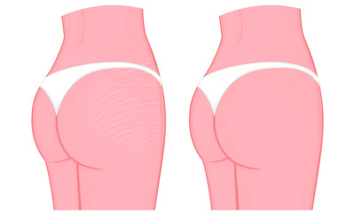 Vector illustration of a woman body problem. Stretch marks on European, Asian female thighs and lower back. For advertising, medical publications, use on package of medicinal products, creams