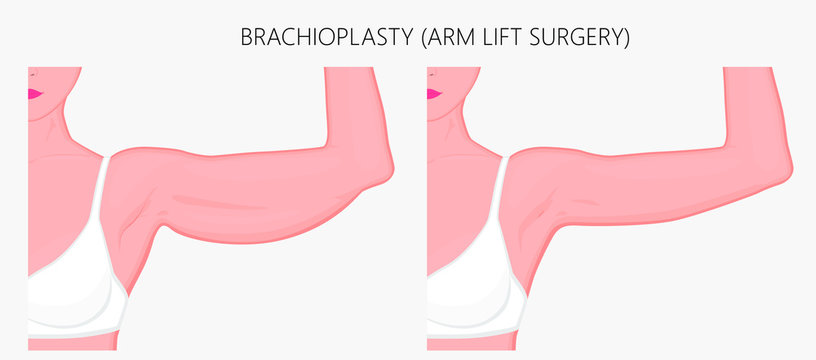 Realistic Vector illustration. Brachioplasty or Upper-Arm Lift plastic surgery in woman. Front view. For advertising of esthetic cosmetic procedures after weight loss; for medical publications