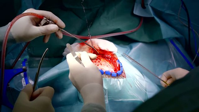 Surgeons do surgery to trepanation of the skull. stitch